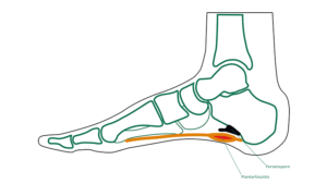 Fersensporn (Plantarfasziitis) - OGAM Orthopädie