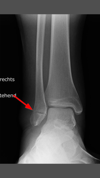 Sprunggelenkfraktur – OGAM Orthopädie